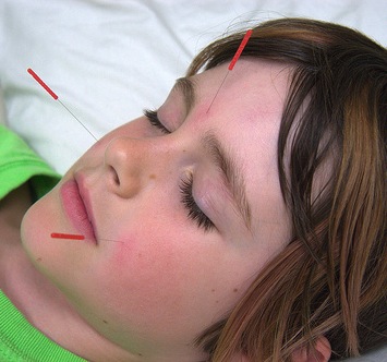 Acupunctura em crianças